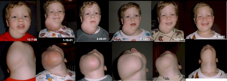Progression after treatment for lymphatic malformations Progression after treatment for lymphatic malformations